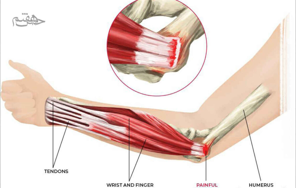 تمرینات اصلاحی برای عارضه آرنج گلف بازان 