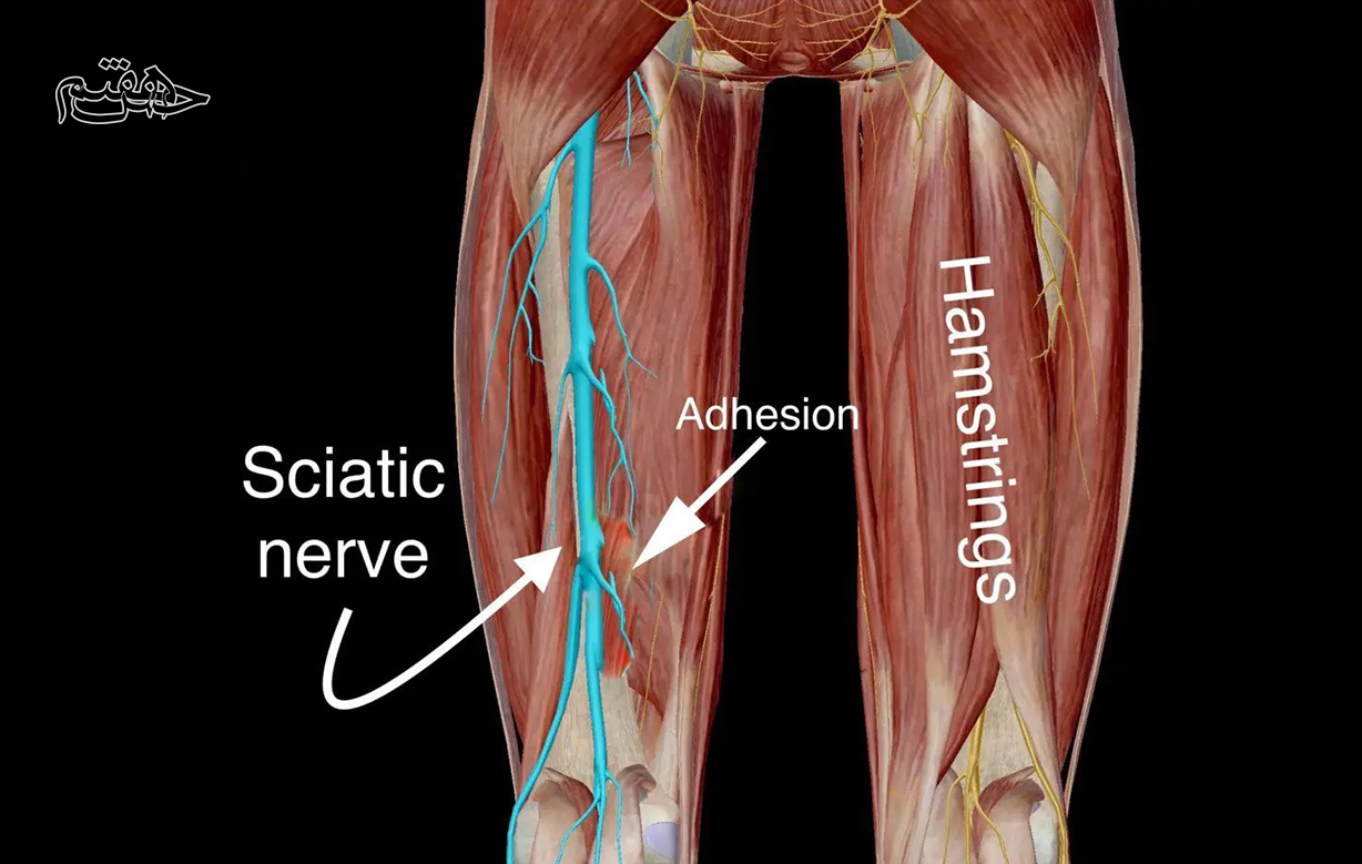 درد سیاتیک