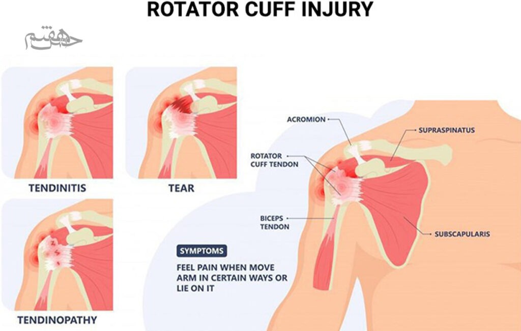 آسیب روتیتور کاف 